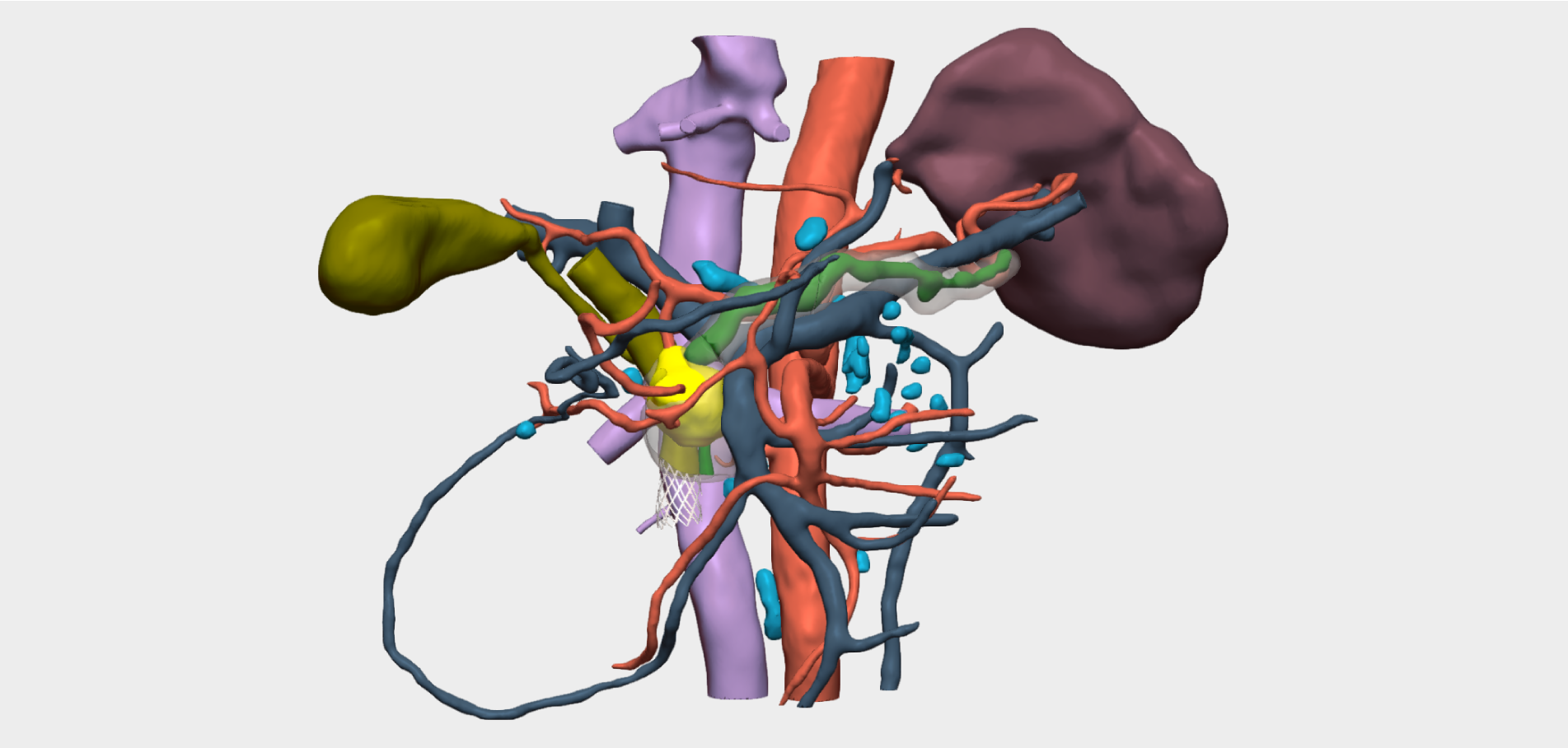 Adenocarcinoma de cabeza de páncreas con modelo 3D