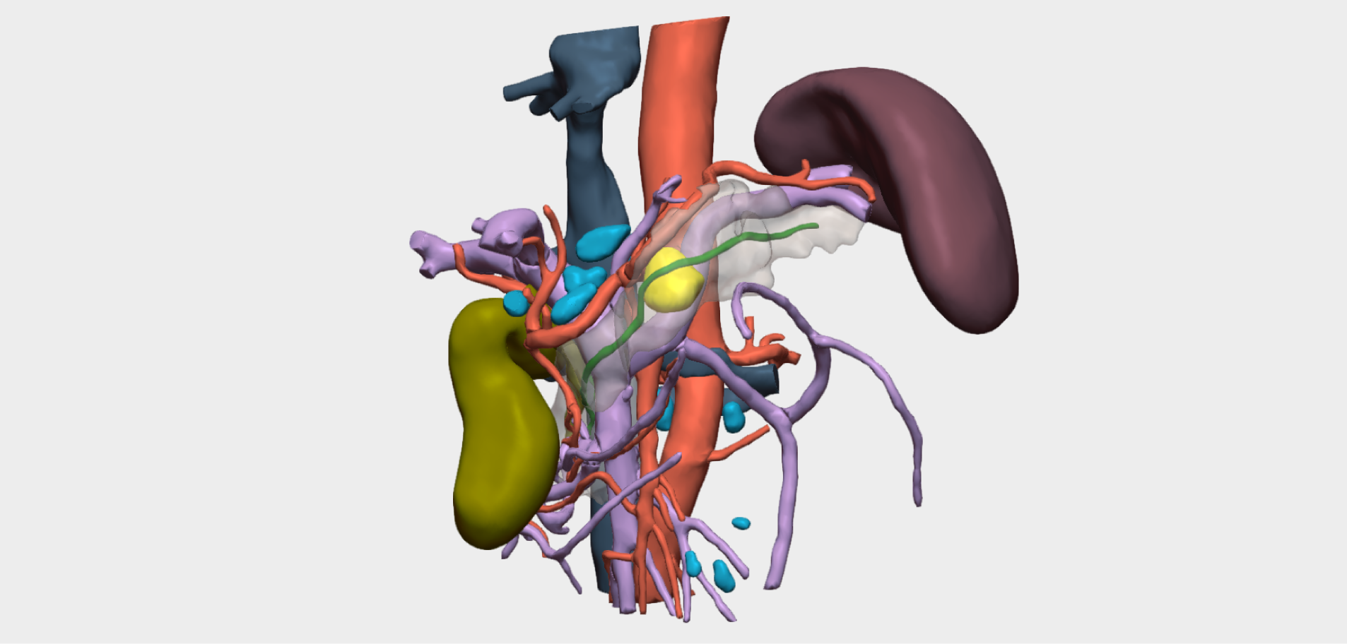 Cirugía de tumor en el cuerpo del páncreas