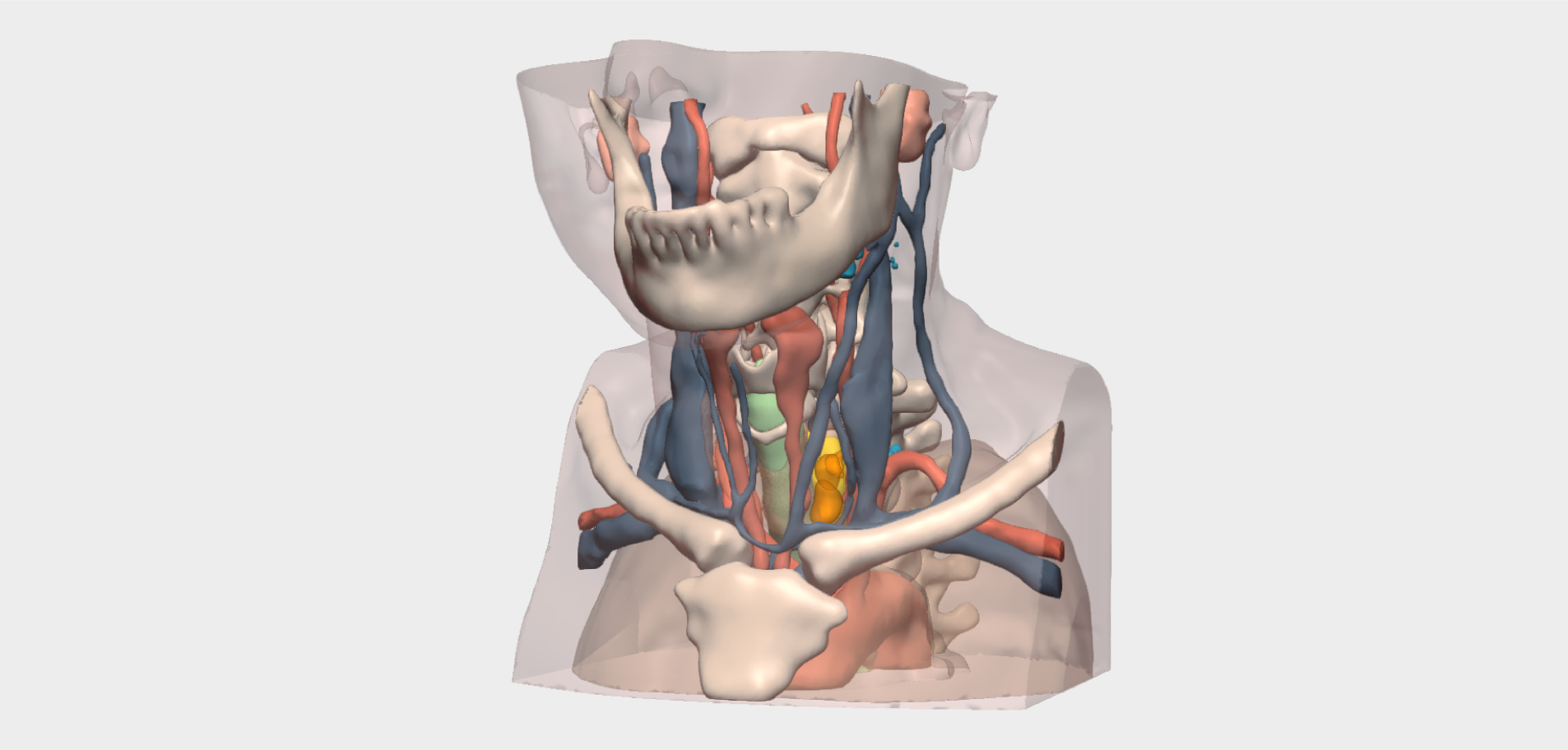 Cirugía de tumor de paratiroides planificada con una reconstrucción 3D