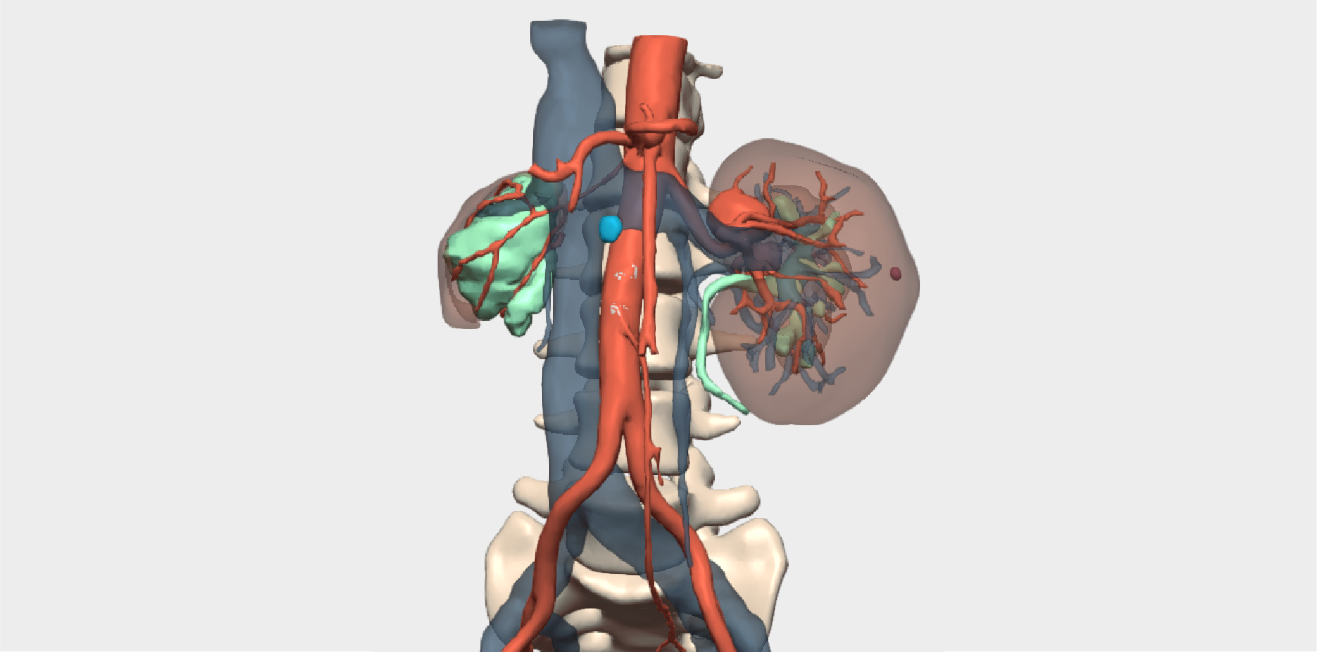 Reparación de aneurismas en arteria renal para salvar el único riñón de una paciente