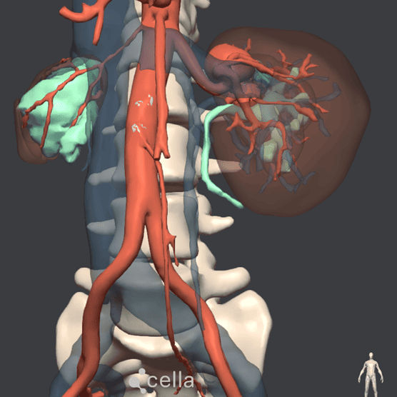 Reconstrucción 3D aneurisma de arterial renal