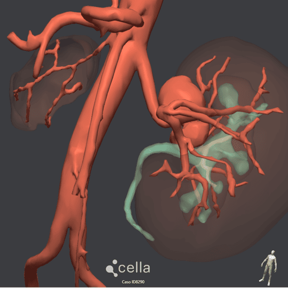 Reconstrucción 3D aneurisma de arterial renal
