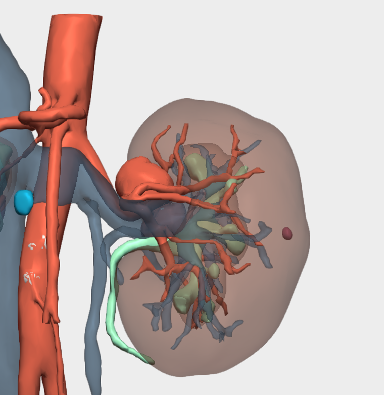 Reconstrucción 3D aneurismas en arterial renal