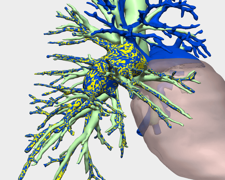 Reconstrucción 3D de sarcoma de arteria pulmonar