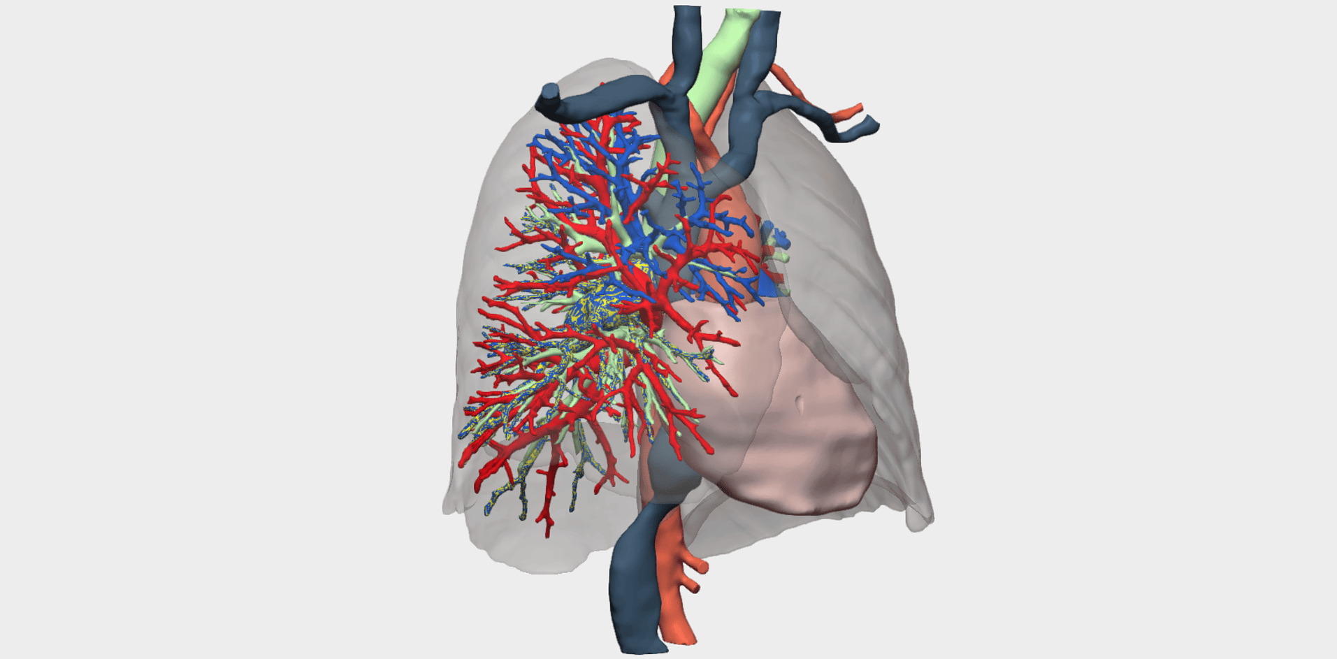 Sarcoma de arteria pulmonar con reconstrucción 3D