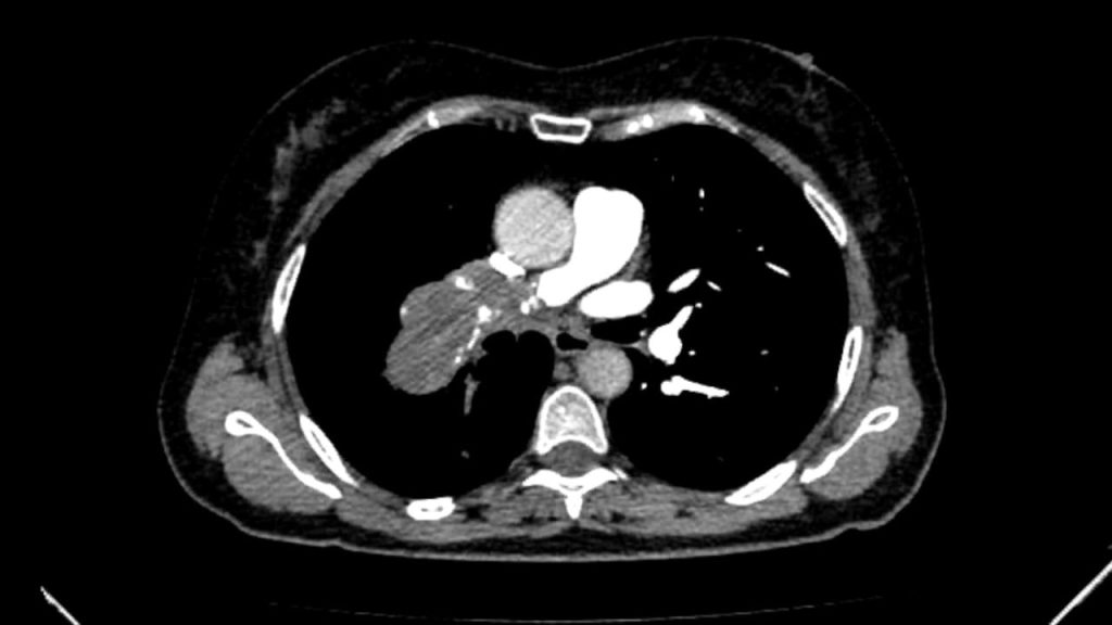 TAC preoperatorio del sarcoma de arteria pulmonar