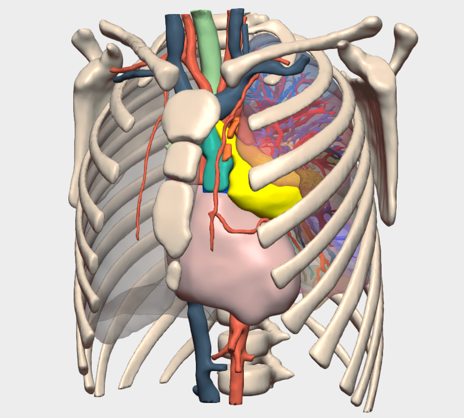 3D-Planned Resection of Costal Ewing Sarcoma in a Paediatric Patient