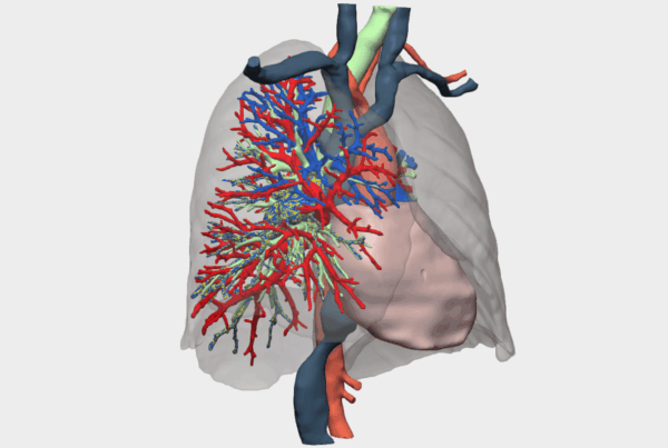 Caso clínico de sarcoma de arteria pulmonar intervenido con un modelo 3D