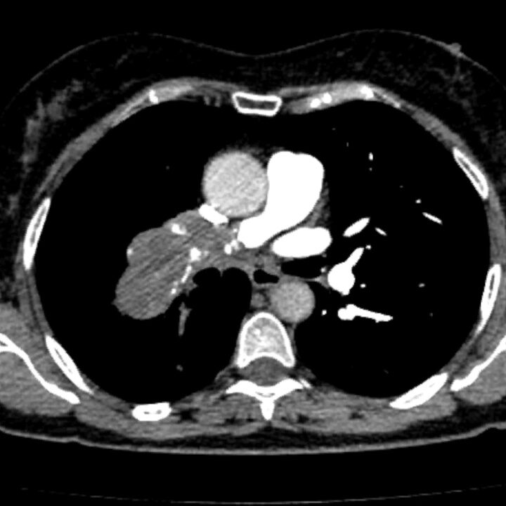 Imagen TAC preoperatorio de sarcoma de arteria pulmonar