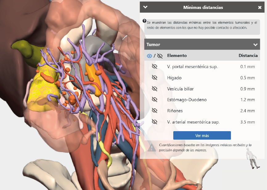 Estudio modelo 3D en cirugía de colon