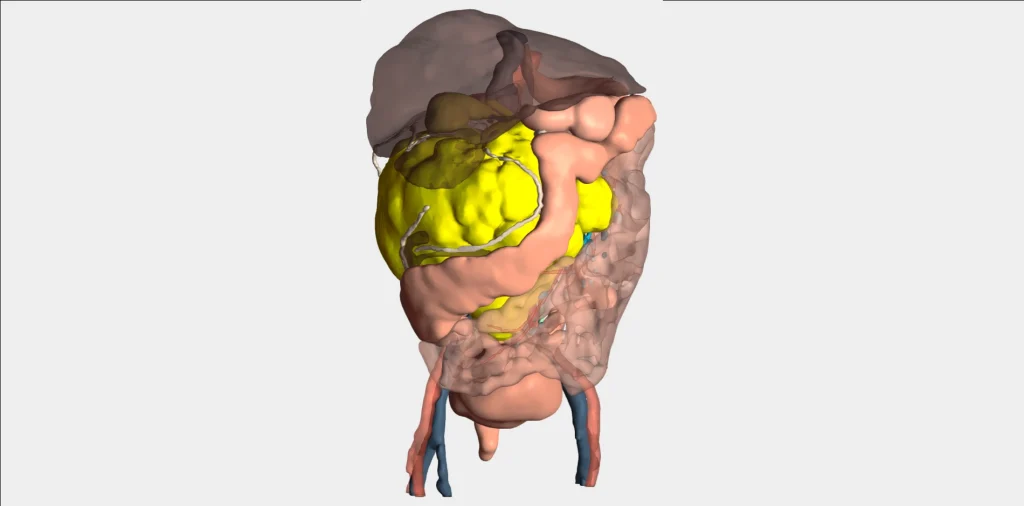 Modelo 3D cirugía masa renal de gran volumen