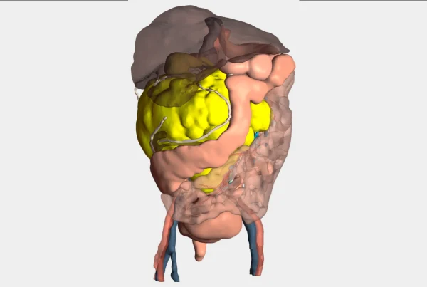 Modelo 3D cirugía masa renal de gran volumen