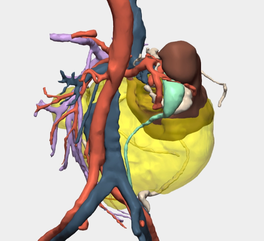 Modelo 3D tumor renal gigante