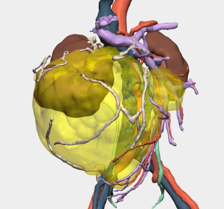 Reconstrucción 3D de tumor gigante en riñón derecho