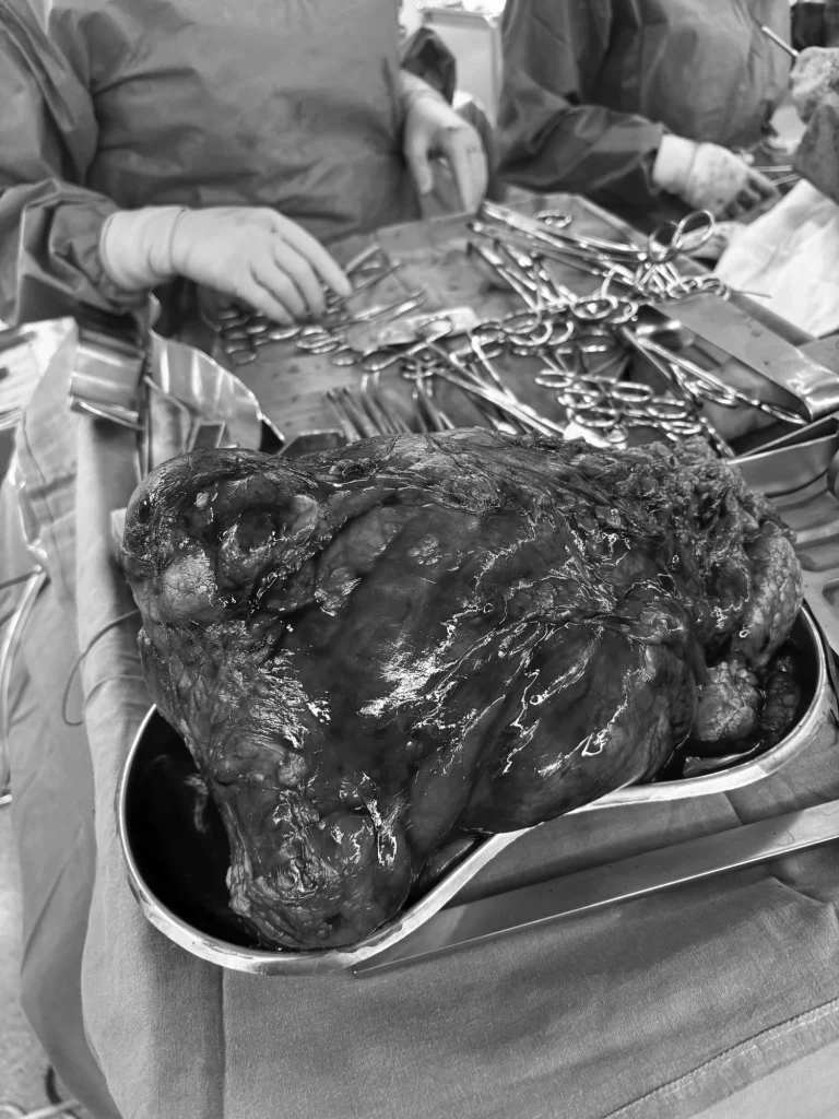  Resección tumor renal de grandes dimensiones.