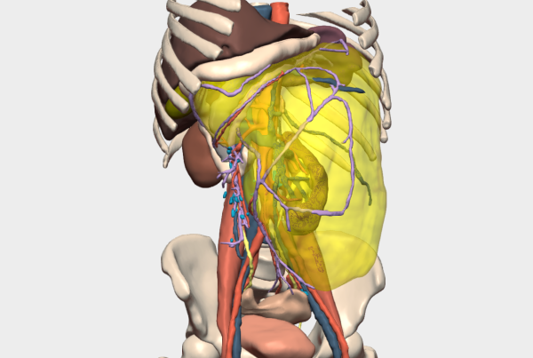 Masa retroperitoneal gigante