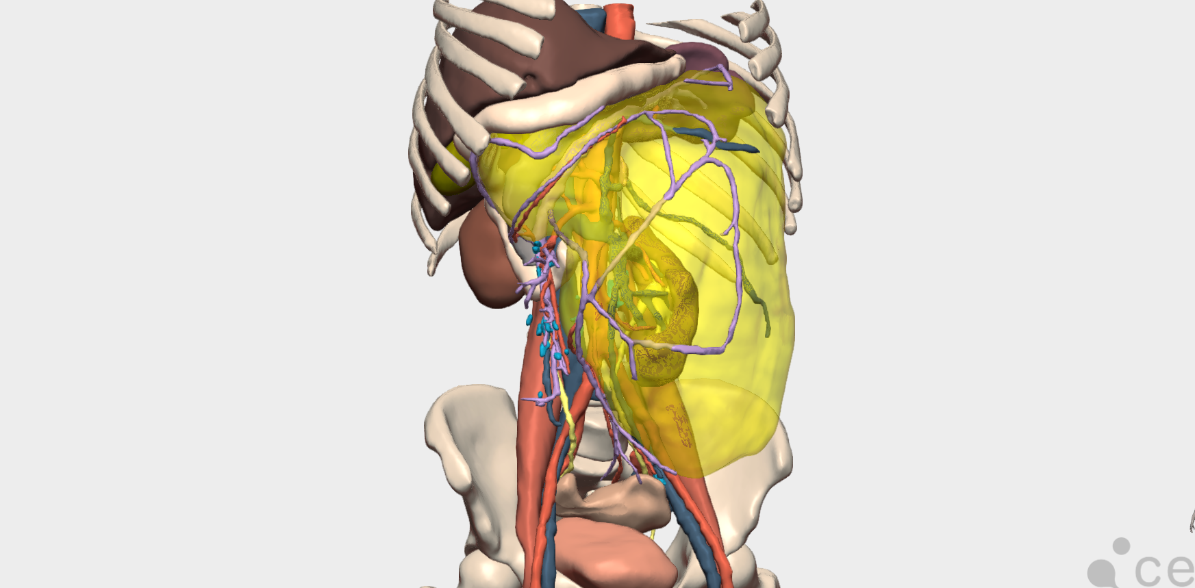 Masa retroperitoneal gigante planificada con un modelo 3D