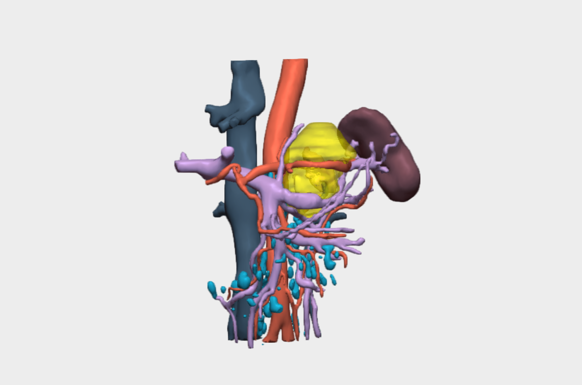 Resección de tumor retroperitoneal complejo con planificación quirúrgica 3D