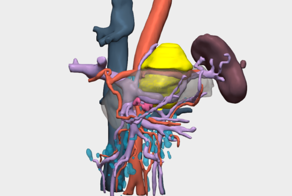 Resección de tumor retroperitoneal complejo con planificación quirúrgica 3D