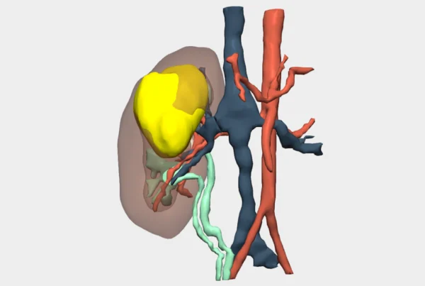 Pediatric laparoscopic heminephrectomy with a 3D model.