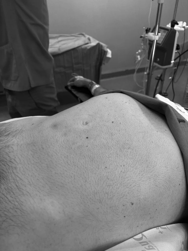 Patient with a giant right renal tumor.