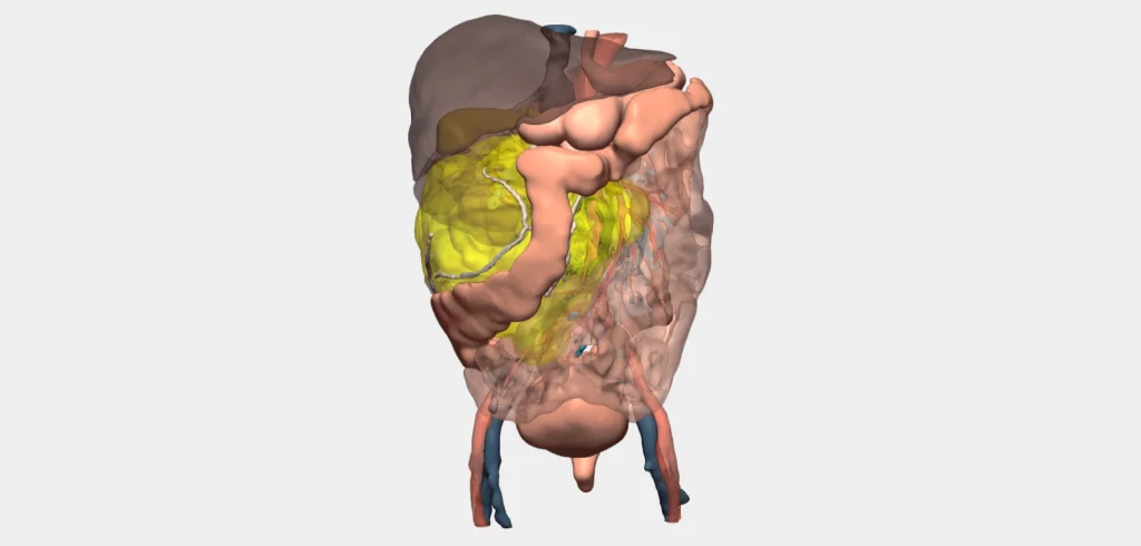 3D Planning of High-Volume Renal Tumour Surgery -