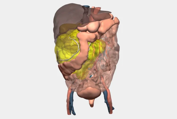 3D Planning of High-Volume Renal Tumour Surgery -