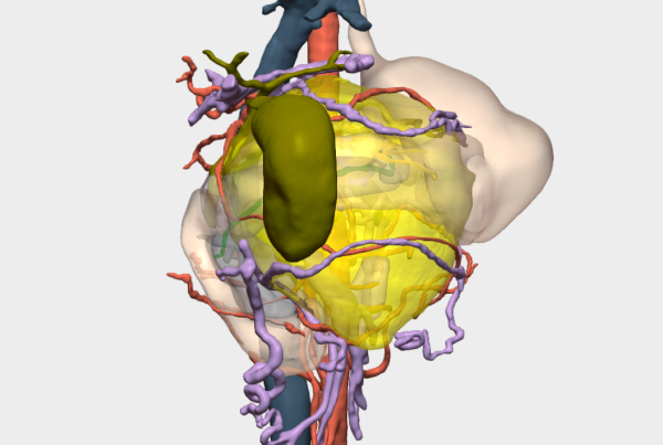 Cirugía de Tumor Sólido Pseudopapilar de Páncreas con modelo 3D en México