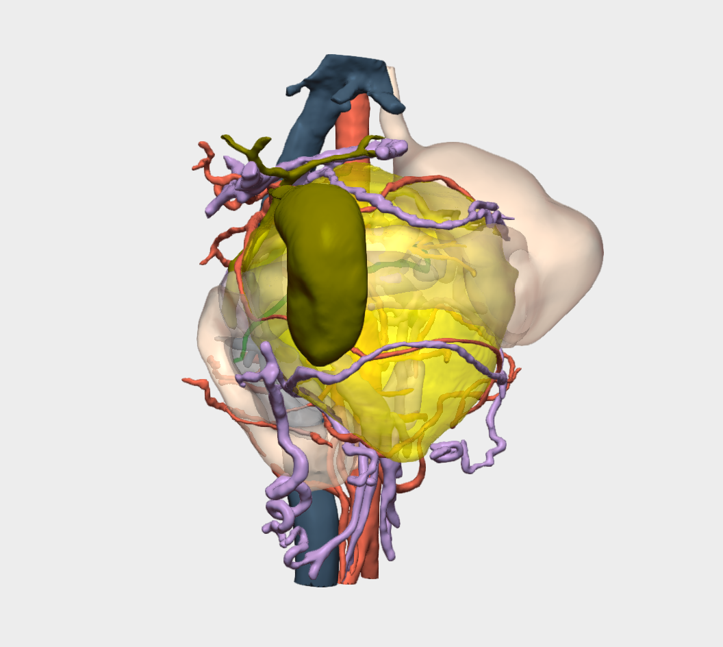 Cirugía de Tumor Sólido Pseudopapilar de Páncreas con modelo 3D en México
