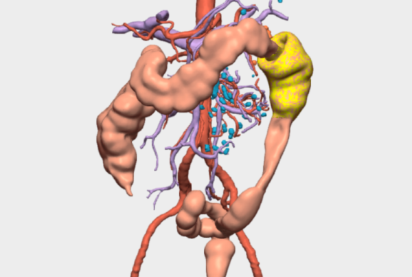 Colectomía segmentaria del ángulo esplénico 3D