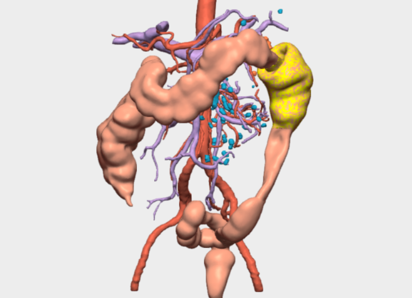 Colectomía segmentaria del ángulo esplénico 3D