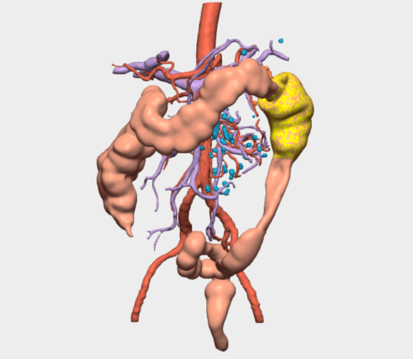 Colectomía segmentaria del ángulo esplénico 3D