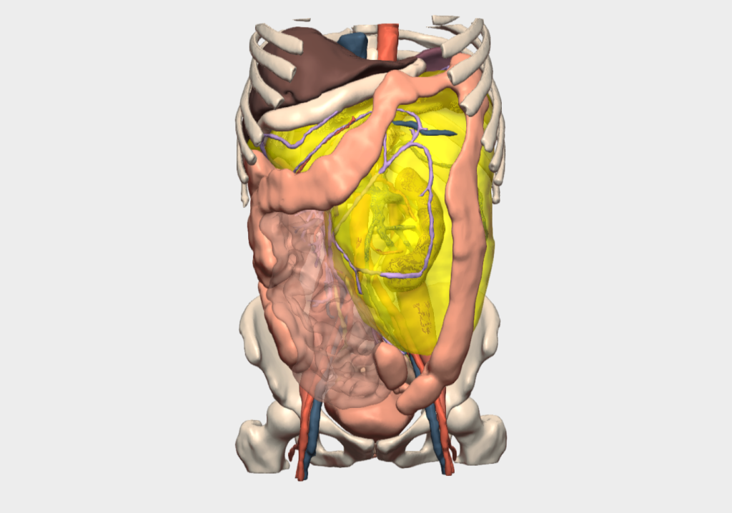 Modelo 3D de tumor retroperitoneal gigante