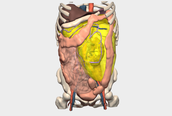 Modelo 3D de tumor retroperitoneal gigante