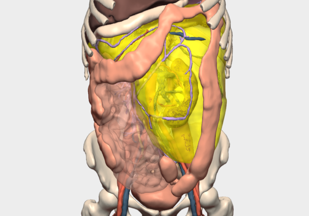 Modelo 3D de tumor retroperitoneal gigante