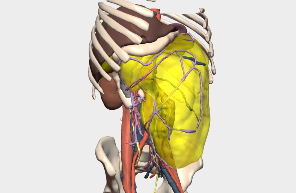 Masa retroperitoneal gigante planificada con un modelo 3D 