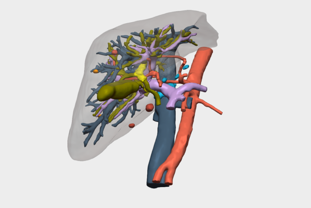 Evitar cirugía tumor Klatskin