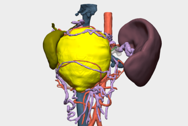 Cirugía de Tumor Sólido Pseudopapilar de Páncreas con modelo 3D en México