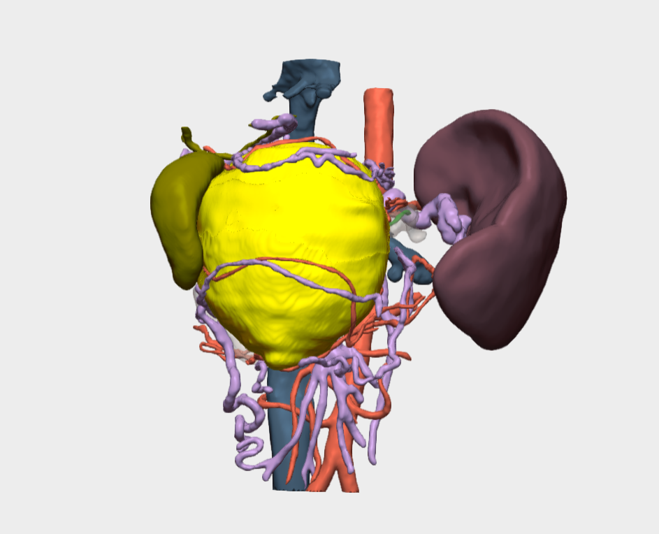 Cirugía de Tumor Sólido Pseudopapilar de Páncreas con modelo 3D en México