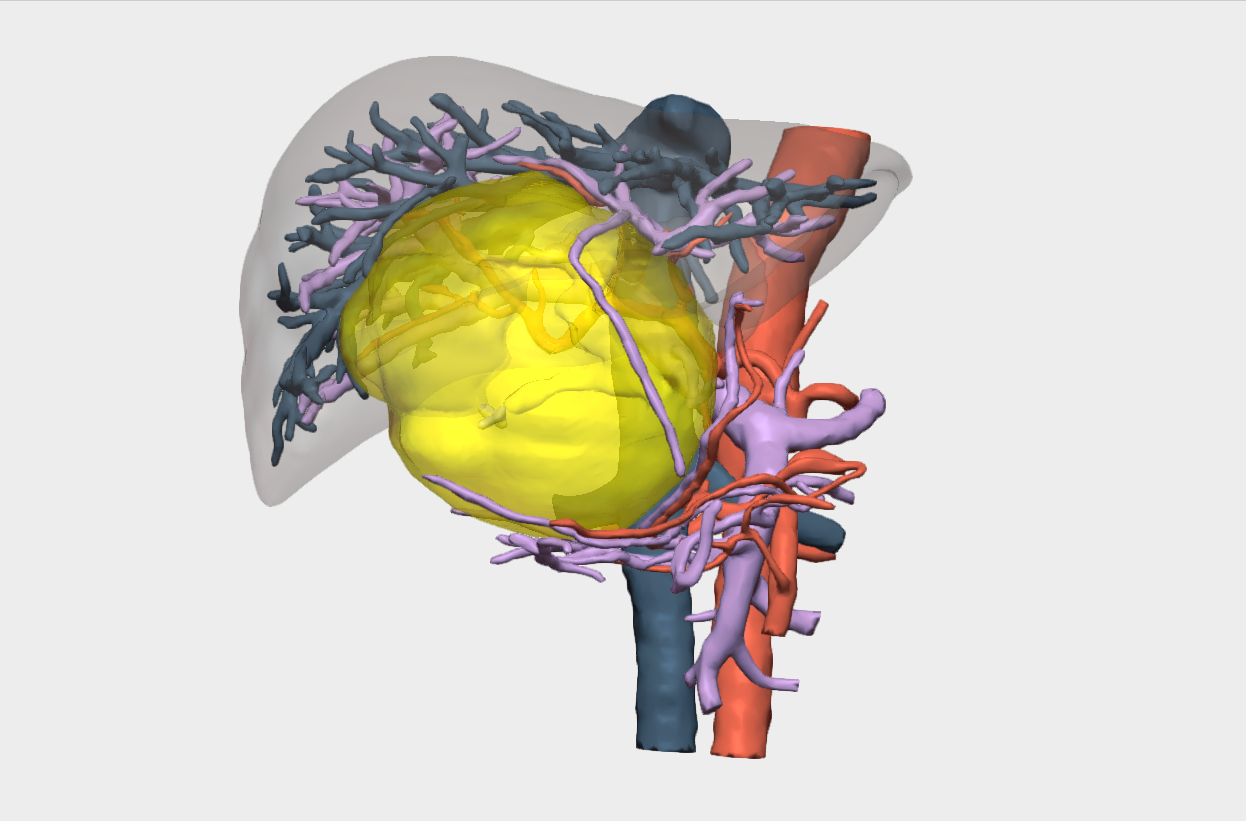 Cirugía de cistoadenoma hepático con planificación 3D