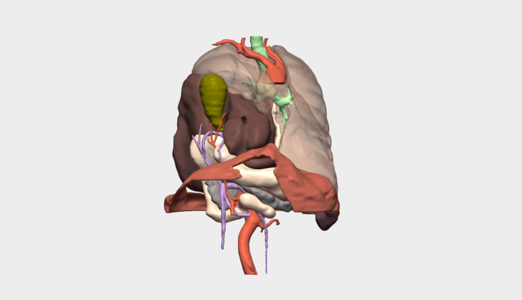 Reparación de hernia diafragmática derecha