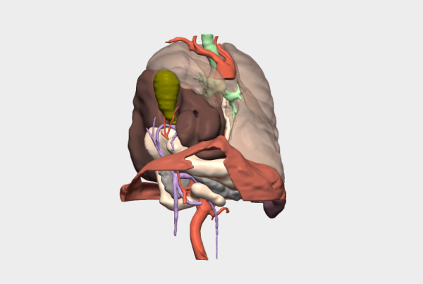 Repair of a large right diaphragmatic hernia and cholecystectomy with 3D planning