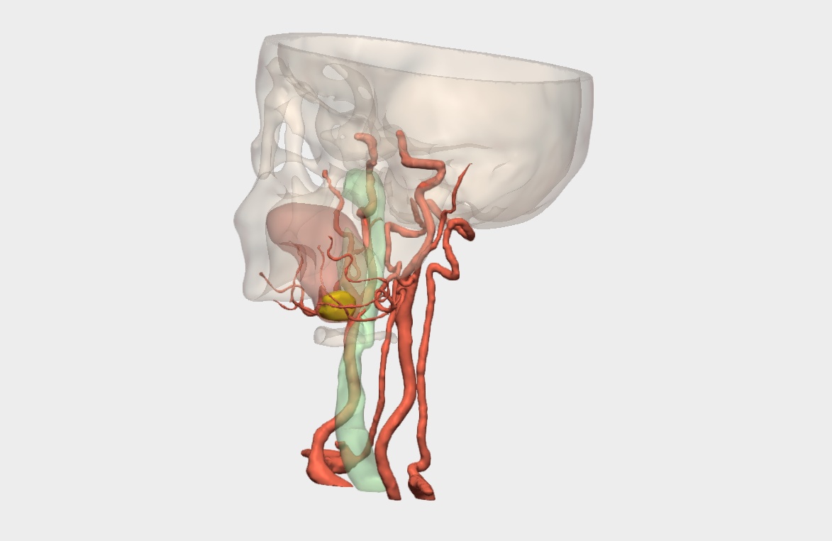 Resección de adenocarcinoma polimorfo de base de lengua con reconstrucción 3D en el Hospital Universitario de Torrejón